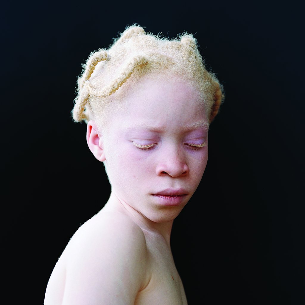 Белый негр. Афроамериканец альбинос Лео. Монголоидные альбиносы.