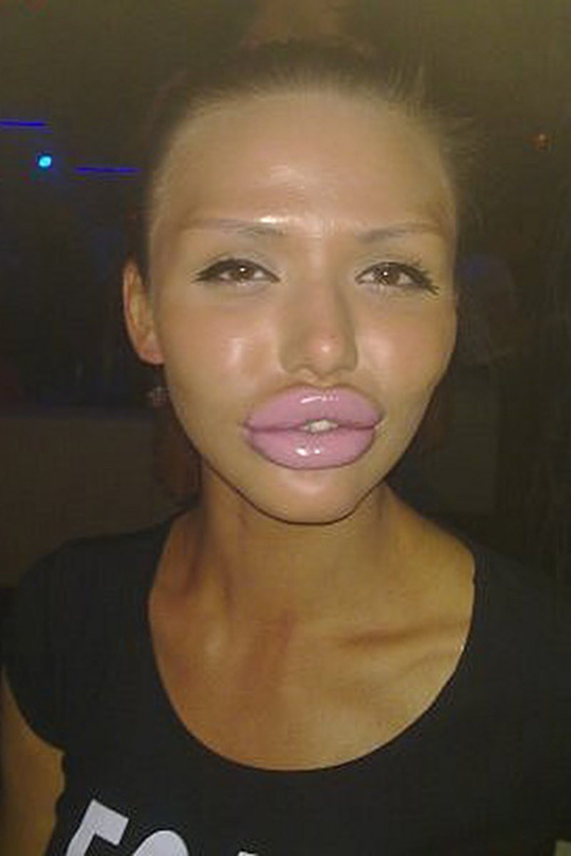 Накаченные силиконом губы