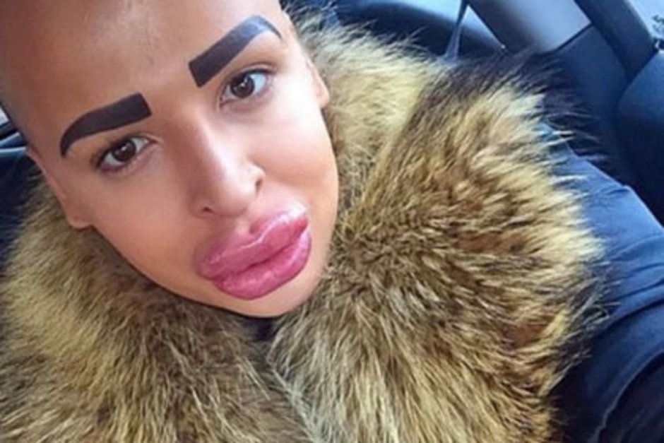 Огромные губы с ботоксом